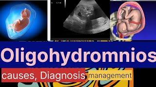 Oligohydramnios causes Diagnosismanagement Dr Naima Bano [upl. by Kerby]