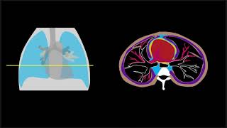 Pneumomediastinum Explained by Prometheus Lionhart MD [upl. by Liahus]