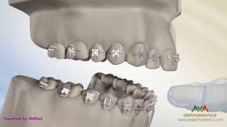 Putting Braces On or Bonding  Indirect Technique [upl. by Crudden]