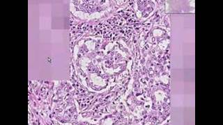 Histopathology LungAdenocarcinoma [upl. by Lemmueu472]