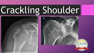 Crackling Shoulder Noise from Shoulder [upl. by Sordnaxela]