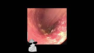 mpacted Ear Wax Removal  NN Ear cleaning 귀지 earwax earwaxremoval [upl. by Sari]