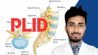 PLID  Prolapsed Lumbar Intervertebral Disc PLID  Physiotherapy  Treatment [upl. by Pascal]