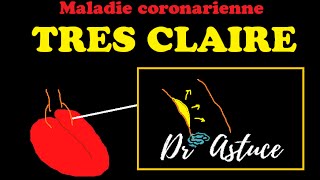 La maladie coronarienne Crise Cardiaque expliquée TRES CLAIREMENT  Dr Astuce [upl. by Eiro]