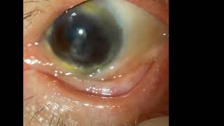 Ocular Cicatricial Pemphigoid [upl. by Anaeli248]