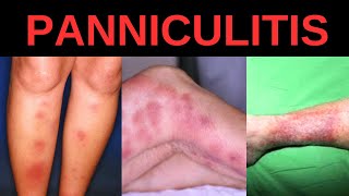 WHAT IS PANNICULITIS SYMPTOMS CAUSES TREATMENT [upl. by Bartel53]