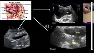 Echographie digestive visualisation du rectum Difficile [upl. by Ramah]