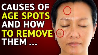 The Real Causes of AGING SPOTS [upl. by Esinrahc]