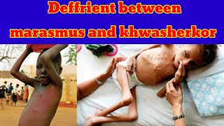 deffrient between marasmus and kwashiorkor  kwashiorkor vs marasmus pashto [upl. by Enywad462]