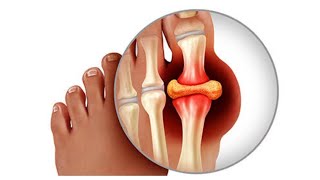 GOUT BY SHUBHAM PANDIT BAMSgoutayurvedapharmacology autocoidsayush pg [upl. by Vere]