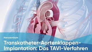 TranskatheterAortenklappenImplantation Das TAVIVerfahren [upl. by Ritter]