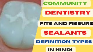 Pits and fissure sealants public Health Dentistrypits and fissure sealants in HindiPits and fissur [upl. by Lednek677]