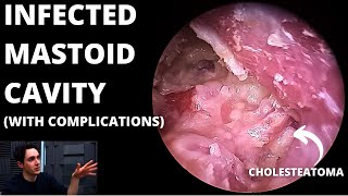 Infected Mastoid Cavity With Cholesteatoma Condylectomy May Be Needed [upl. by Bethesda]