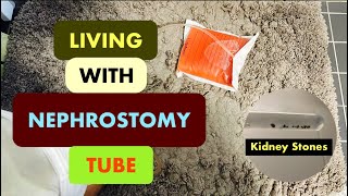 Nephrostomy Tube  Nefrostomi  Nephrostomy Journey  Nephrostomy Tube Care  Nephrostomy Tips [upl. by Nydnarb950]