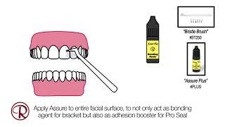 Using Pro Seal to prevent decalcified lesions [upl. by Suiratnod]