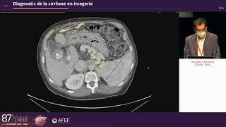 Diagnostic de la cirrhose en imagerie  R Sartoris [upl. by Elsbeth]