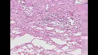 Histopathology ColonIschemic enterocolitis [upl. by Aisac]