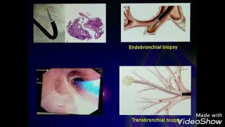 Transbronchial Lung Biopsy TBLB  TBBx [upl. by Cila]