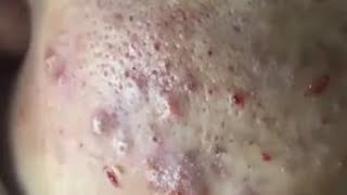 BLACKHEADS WHITEHEADS CYSTS 😮 Acne Treatment for Blackheads Whiteheads Milia [upl. by Rodolphe206]