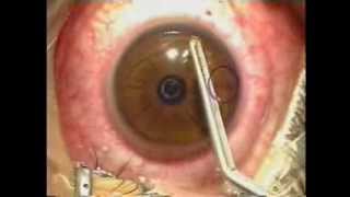 Lasik Laser Eye Surgery Procedure  Live Surgery [upl. by Namia]