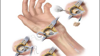 LRTI Ligament Reconstruction amp Tendon Interposition Surgery for 1st CMC JOINT Arthritis of Wrist [upl. by Box]