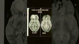 MRI BRAIN HEMORRHAGE education medicalimaging radiology [upl. by Sirmons]