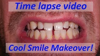 Time lapse of Dental Composite Veneers to close gaps [upl. by Acinnod143]