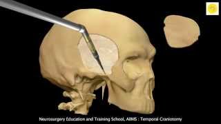 Neurosurgery 3D Animation Video  Temporal Craniotomy [upl. by Sibel50]