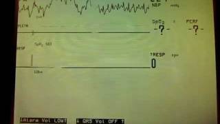 Asystole Apnea alarms [upl. by Musette]