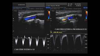 stenosi dellarteria carotide interna sinistra  ICA [upl. by Rhynd116]
