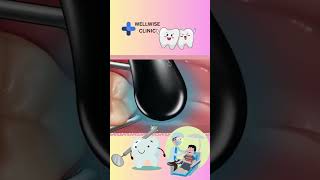 Fixing Damaged Teeth teeth yt youtubeshorts [upl. by Ellehcit]