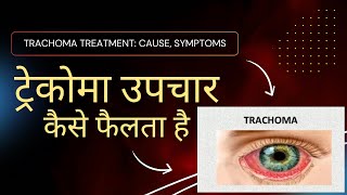 quotTrachoma Treatment Cause Symptoms  IN HINDI ट्रेकोमा उपचारकैसे फैलता है” [upl. by Eulalia973]