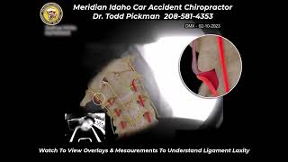 Digital Motion X Ray Normal Vs Spinal Ligament Injury with 2 S intro [upl. by Farrow428]