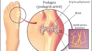 Podagra kasalligi haqida Подагра касаллиги [upl. by Aissatsan]