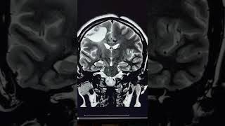 Wallerian degeneration of Corticospinal tract [upl. by Hube]