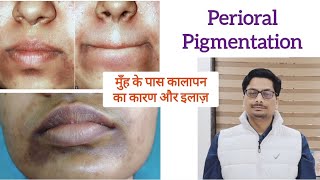 मुँह के पास कालापन का कारण और इलाज़ Perioral Pigmentation pigmentationtreatmentathome pigmentation [upl. by Edasalof]