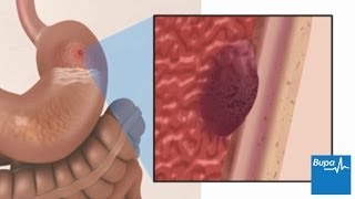 How a peptic ulcer develops  Bupa Health [upl. by Lennahs]