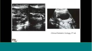 Fetal Hydronephrosis [upl. by Hayward]