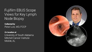 Advances of the Fujifilm EBUS Scope Views for Lymph Node Biopsy [upl. by Hiamerej]