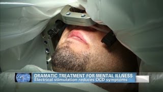 Sanjay Gupta MD Deep brain stimulation helps OCD patient [upl. by Monreal504]