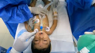 Pediatric Anesthesia Intubation Lessons  Anesthesiologist POV [upl. by Nawram]