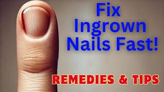 Cure Ingrown Fingernails Fast Proven Tips amp Home Remedies [upl. by Genisia]