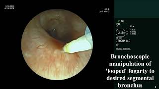 Endobronchial blocker placement  Loop and park technique [upl. by Atteuqnas]