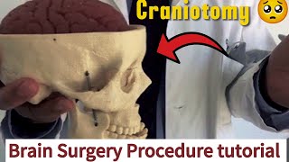 Brain Surgery procedureHow to perform Brain surgeryCraniotomy surgery 3D animation [upl. by Nylitak]