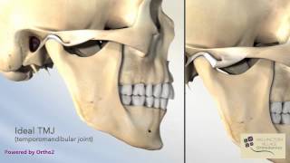 Closed Lock TMJ Lock Jaw  Wellington Village Orthodontics [upl. by Anyahs906]