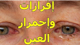 إحمرار العين وخروج إفرازات منها  معلومات هامه عن هذه المشكلة [upl. by Enellij554]