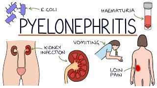 Understanding Pyelonephritis Kidney Infections [upl. by Ahtebbat84]