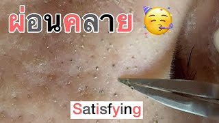 กดสิว blackheads filaments on nose remove with tweezers [upl. by Alimrahs]