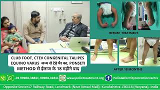 CTEV CONGENITAL TALIPES EQUINO VARUS जन्म से टेढ़े पैर का PONSETI METHOD से ईलाज के 18 महीने बाद [upl. by Algie969]