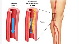 Claudication in legs  treatment  exercise  claudication Pathophysiology [upl. by Joana]